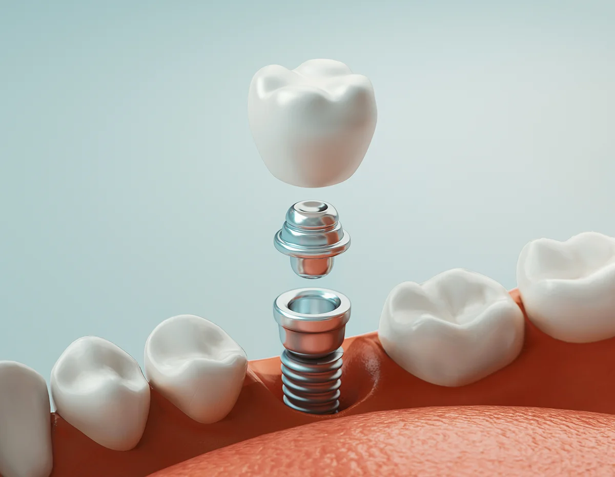 Partes de un implante dental