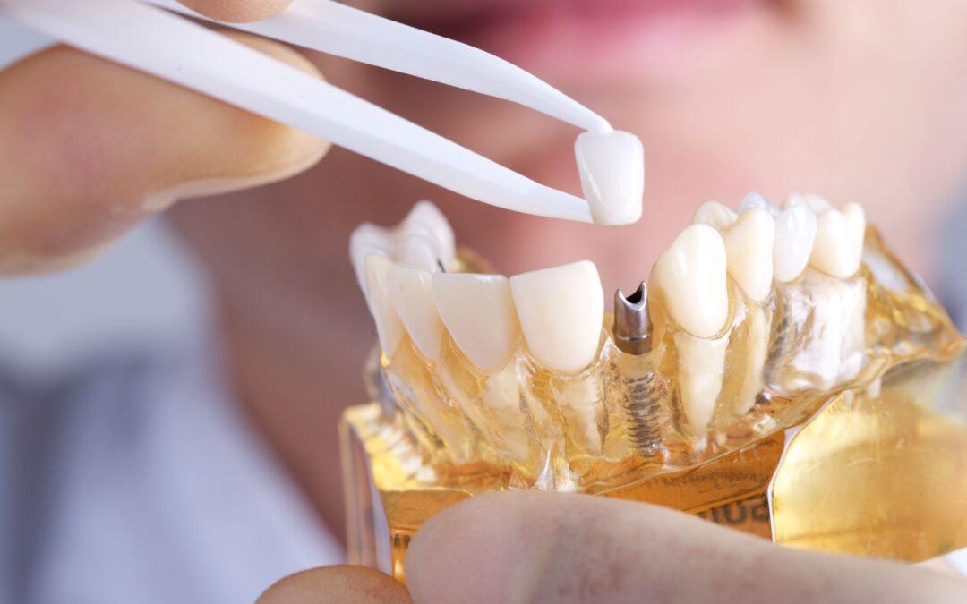 Lo que no te cuentan sobre los implantes dentales