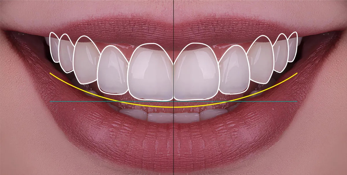 Diseño Digital de Sonrisa