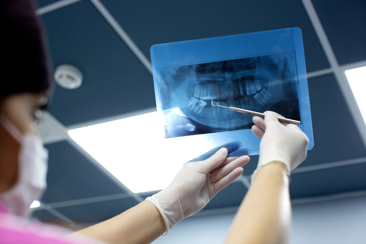 Implantes tras pérdida dental