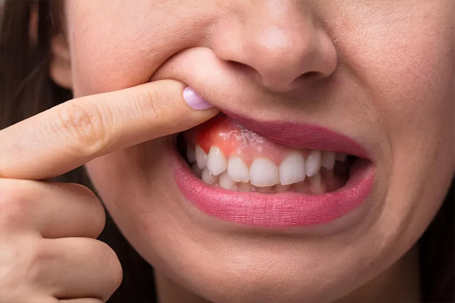 Mujer con gingivitis o inflamación de encías